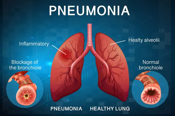 Pneumonia Meaning in Urdu